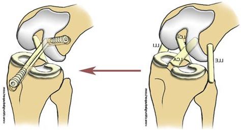 Genouillère Quadriceps